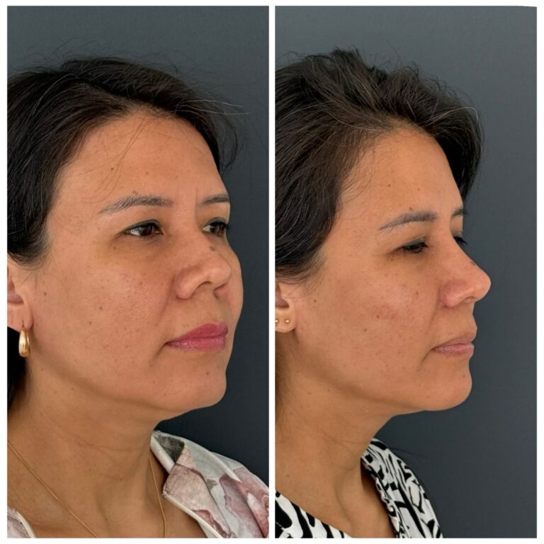 Rinoplastía - resultados - caso 22